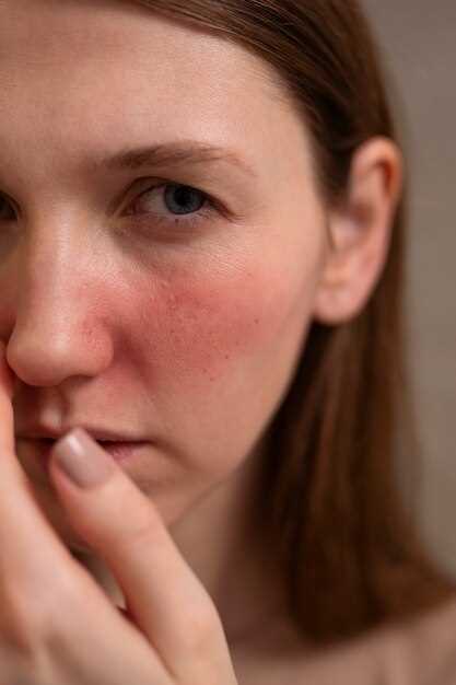 Using Propranolol for Rosacea